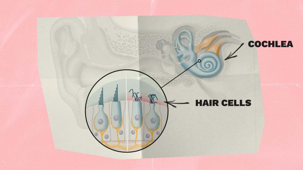 Illustration of cochlea and hair cells damaged by noise or aging, contributing to tinnitus