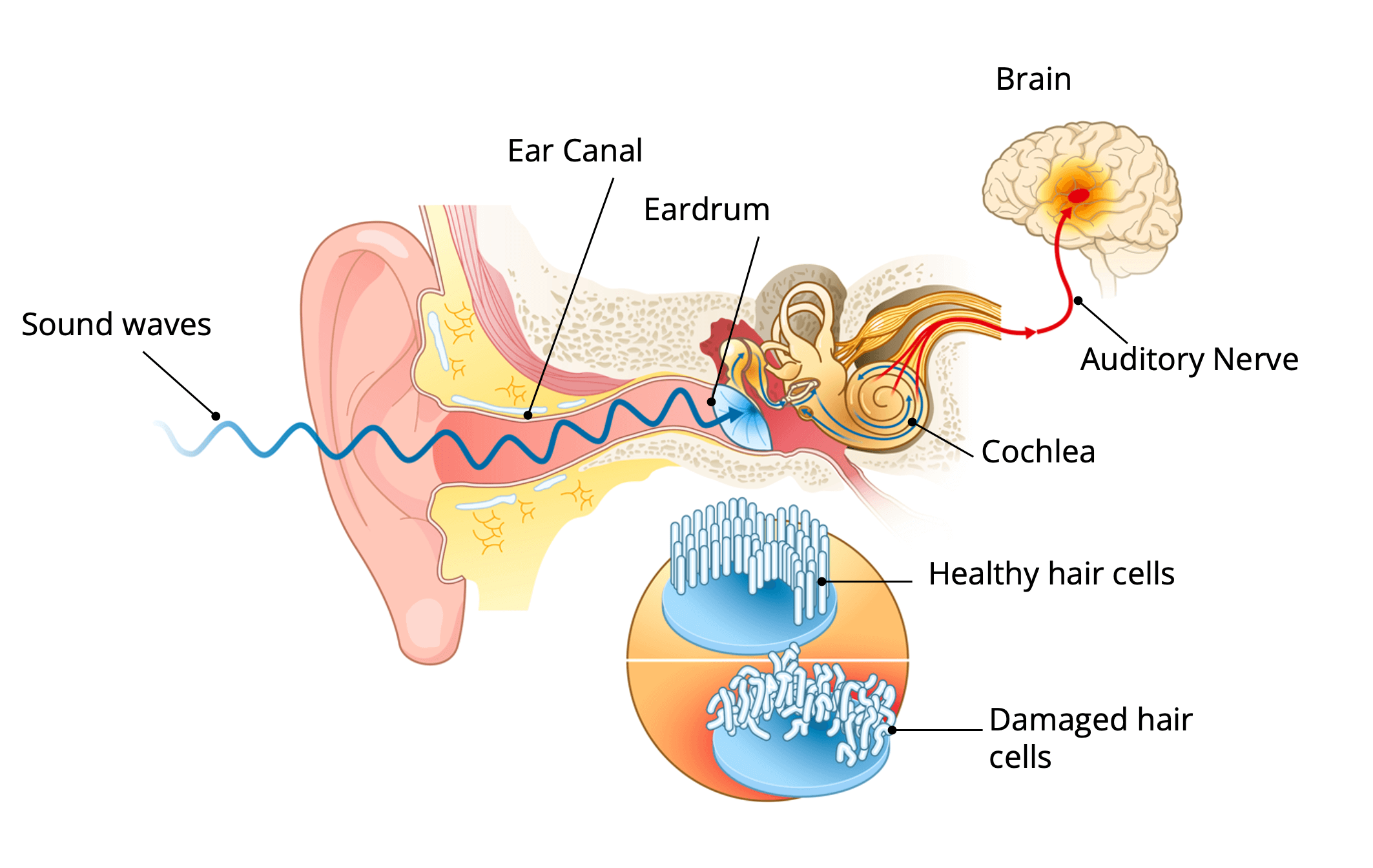 Diagram dat laat zien hoe geluid door de gehoorgang naar het slakkenhuis (cochlea) reist, met gezonde versus beschadigde haarcellen en het gehoorsignaal dat de hersenen bereikt.